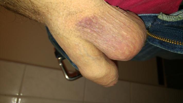 Blue balls. Stiches and still horny.