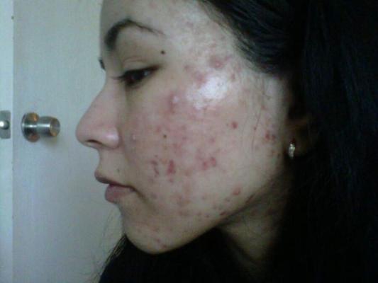 Pimples - amateur faces covered with ugly acne spots