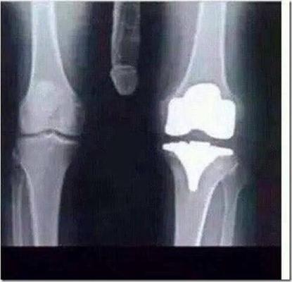 Ma radiographie de mon arthroplastie du genou